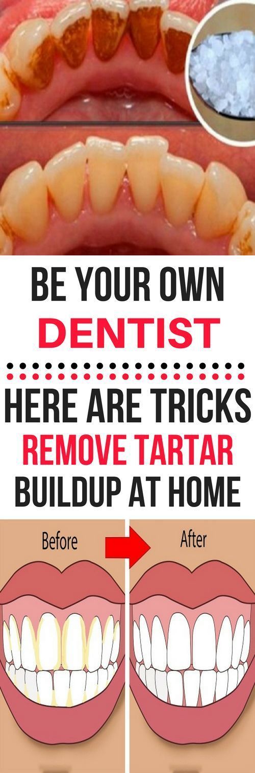 BE YOUR OWN DENTIST! HERE ARE TRICKS TO REMOVE TARTAR BUILDUP AT HOME