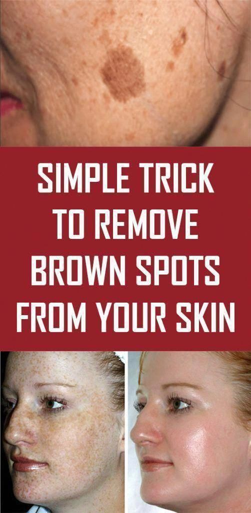 SIMPLE TRICK TO REMOVE BROWN SPOTS FROM YOUR SKIN