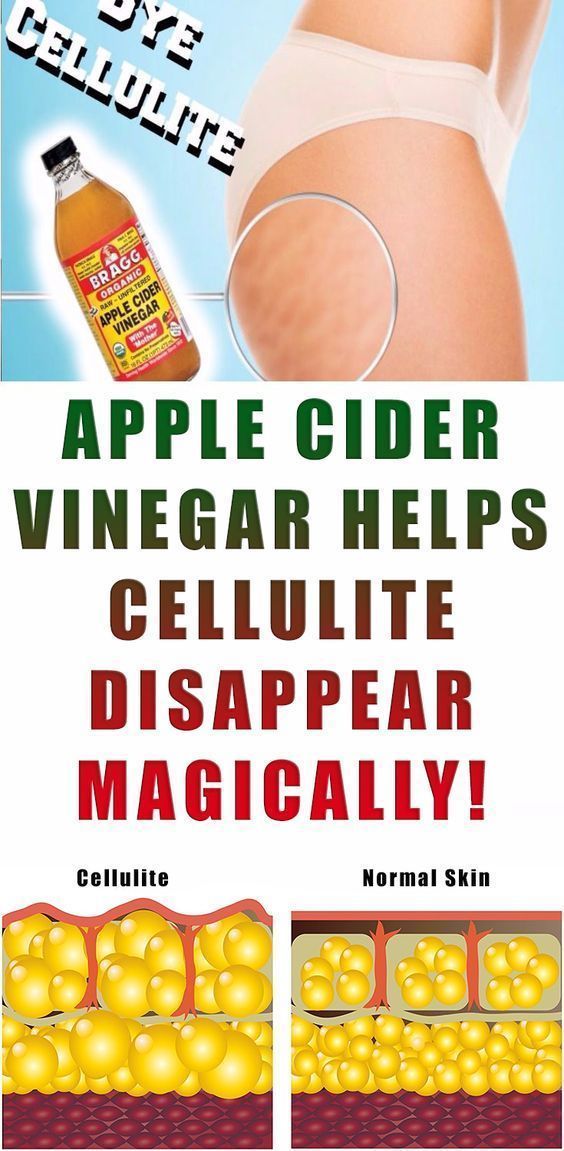 Make the Cellulite Disappear and Lose Weight With Apple Cider Vinegar